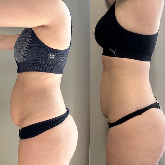 Ce que vous devez savoir sur le diastasis recti